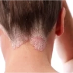 Psoriasis